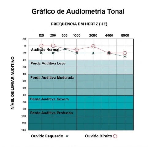 Gráfico de audiometria tonal (audiograma) com frequências em Hertz e classificação de níveis de limiar auditivo de audição normal a perda profunda.